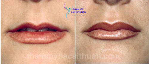 tao-hinh-moi-trai-tim-truoc-sau-1