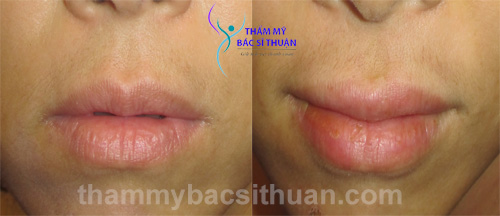 tao-hinh-moi-trai-tim-truoc-sau-2