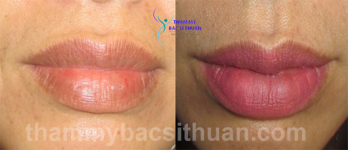 tao-hinh-moi-trai-tim-truoc-sau-4