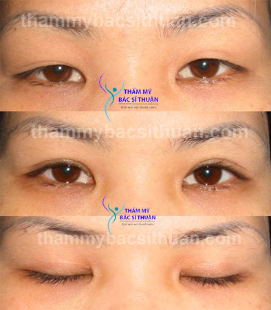 hinh-anh-cat-mat-2-mi-1