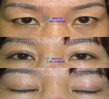 hinh-anh-cat-mat-2-mi-2