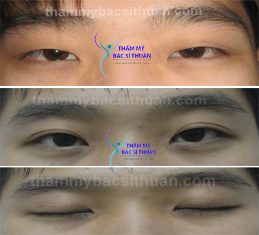 hinh-anh-cat-mat-2-mi-3