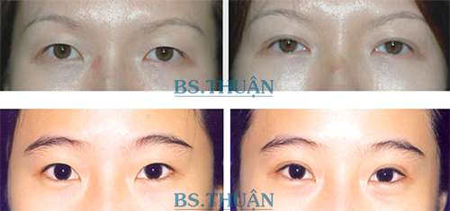 bam-mi-mat-han-quoc-3