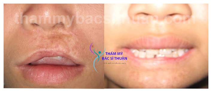 hinh-anh-xoa-seo-moi-4