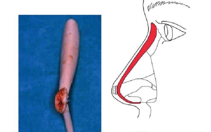 nang-mui-boc-sun-4_1