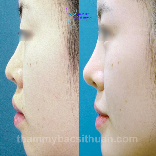 nang-mui-boc-sun-truoc-sau-1