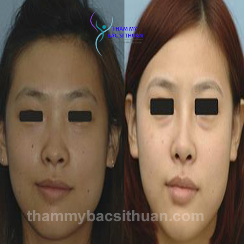 nang-mui-boc-sun-truoc-sau-2