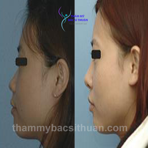 nang-mui-boc-sun-truoc-sau-3