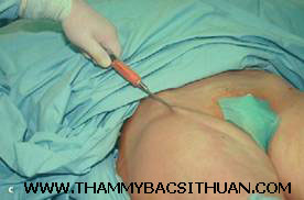 cấy ghép mỡ tự thân