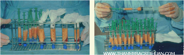 cấy ghép mỡ tự thân