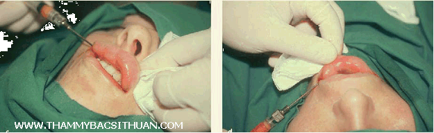 cấy ghép mỡ tự thân