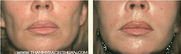 cấy ghép mỡ tự thân