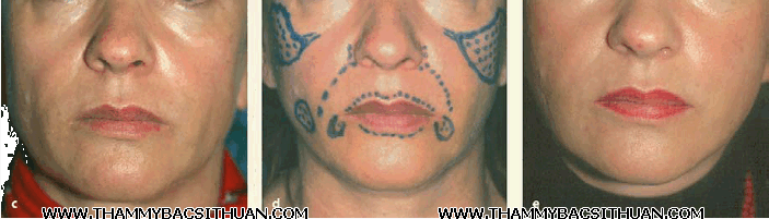 cấy ghép mỡ tự thân