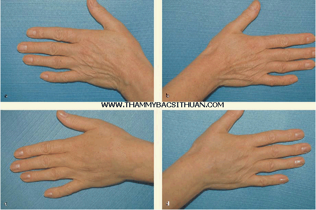 cấy ghép mỡ tự thân