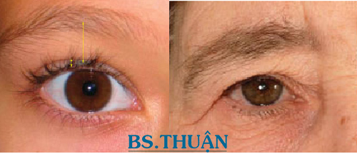 nâng cao chân mày