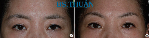 nâng cao chân mày