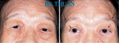 nâng cao chân mày