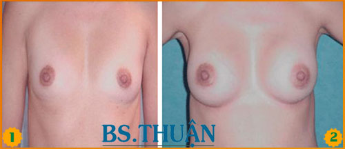 nang nguc bang tui don