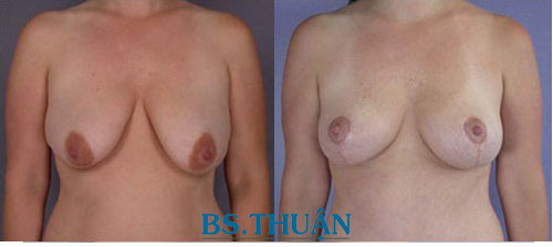 nâng ngực chảy xệ