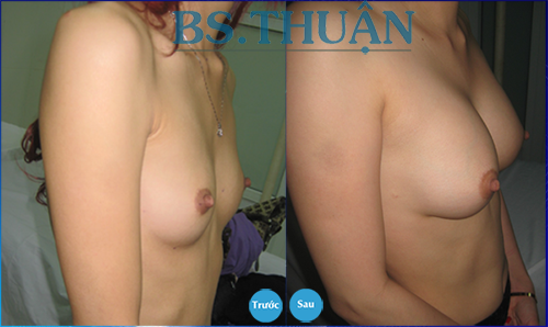 nang nguc bang tui don