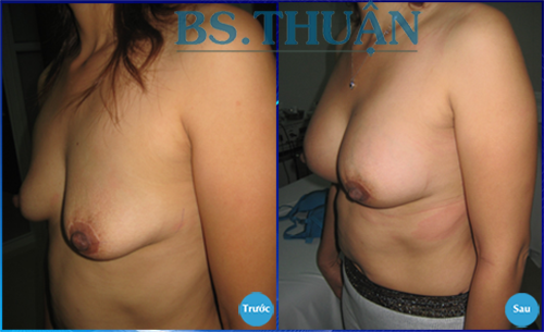 nang nguc bang tui don