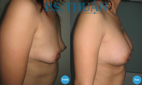 nang nguc bang tui don