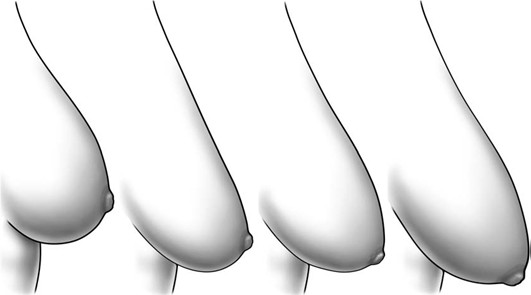 nâng ngực chảy xệ