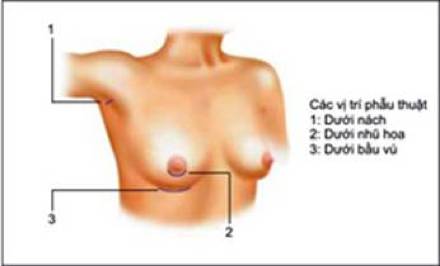 nang nguc bang tui don