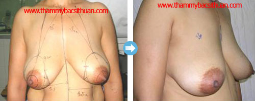 thu gọn vú phì đại