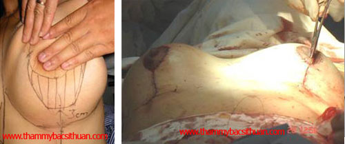 thu gọn vú phì đại