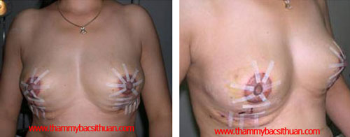 thu gọn vú phì đại