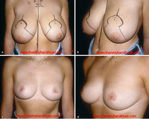 thu gọn vú phì đại