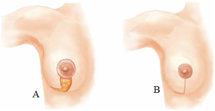 thu gọn vú phì đại