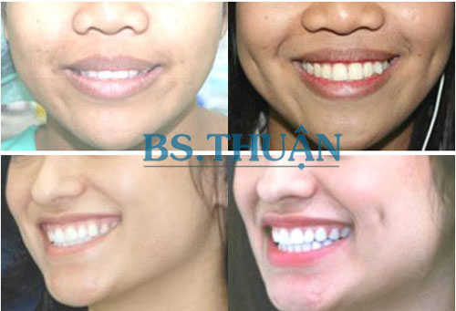 má lúm đồng tiền