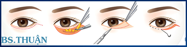 cắt mí mắt dưới