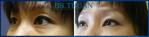 cắt mí mắt dưới