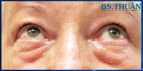 cắt mí mắt dưới