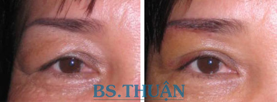 nâng mi mắt trên