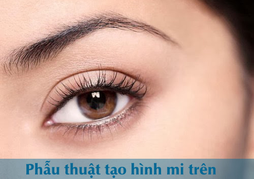 cắt mi mắt trên