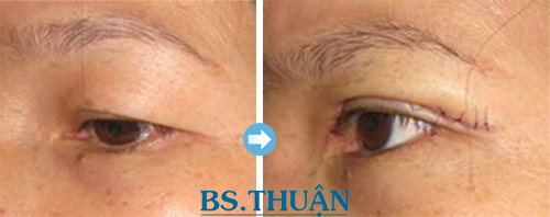 cắt mi mắt trên