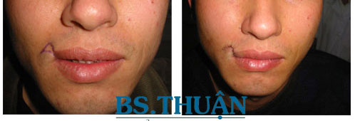 xóa sẹo ở môi