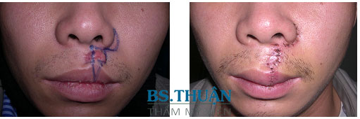 xóa sẹo ở môi