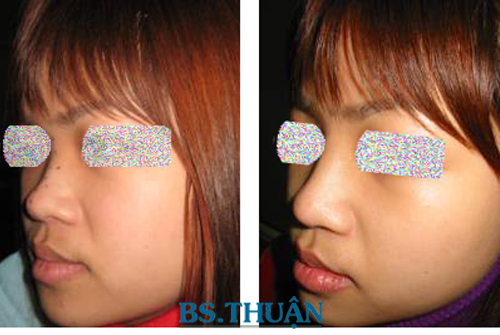 nâng cao sống mũi